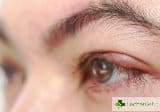 Ечемик на окото – причини симптоми и лечение